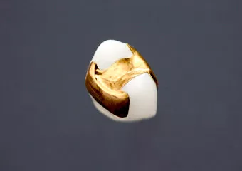ゴールドインレー(20K)