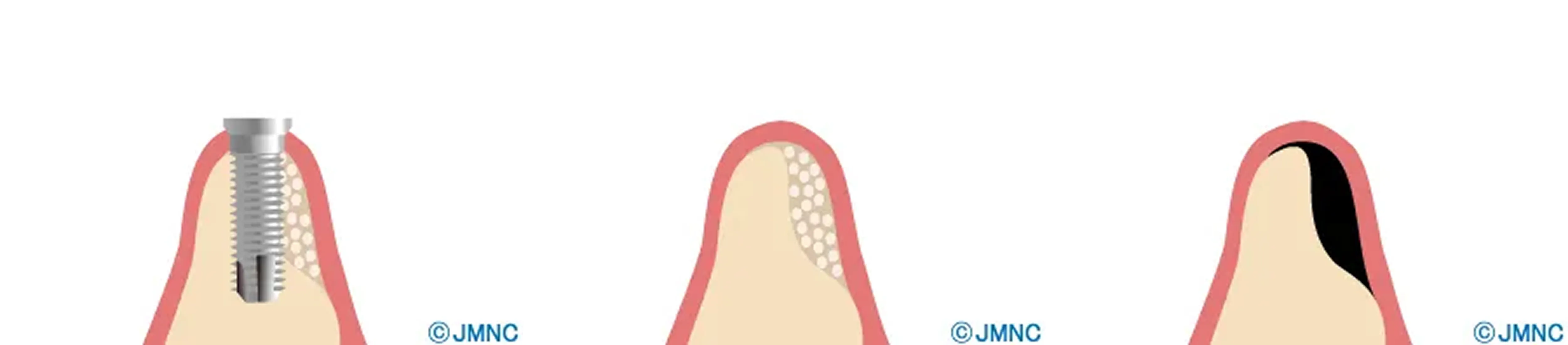 骨の量が不足しているイメージ