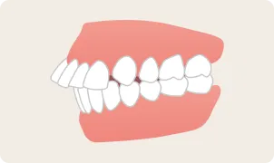 出っ歯の画像