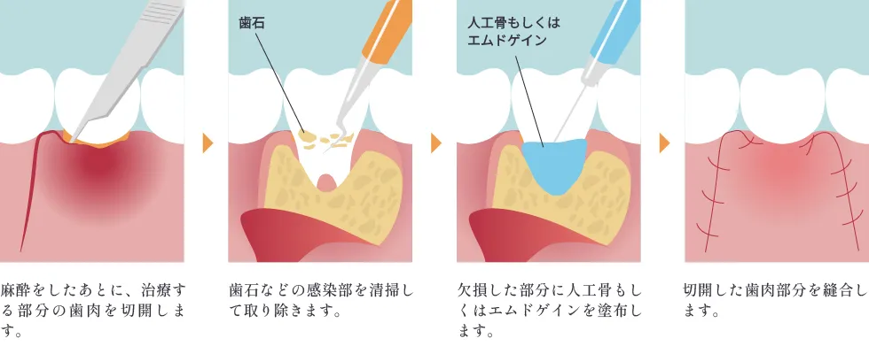 エムドゲイン法の流れのイメージ画像