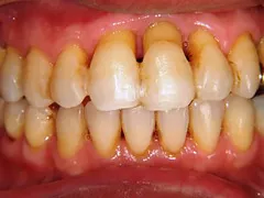 歯周病の状態を示す口腔内写真